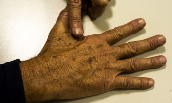 Câncer de pele gera R$ 4,6 milhões em custos hospitalares quase 2 anos
