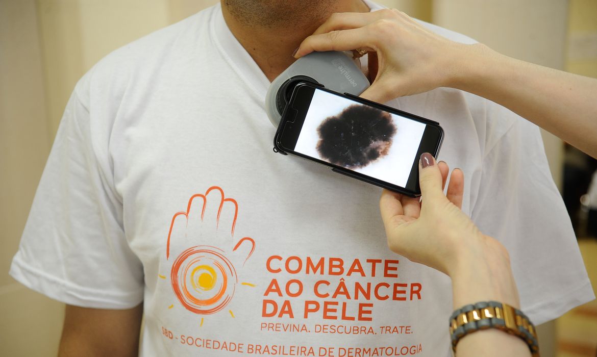 Mutirão atende população hoje, no dia de combate ao câncer de pele