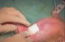 Cirurgia na Santa Casa de Mogi corrige rara anomalia em recém-nascida