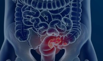 Pacientes com câncer colorretal são diagnosticados em estágio avançado