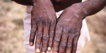 Região tem 21 casos confirmados da Monkeypox