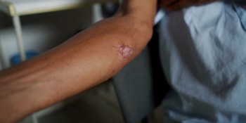 Doença de Chagas e leishmaniose são o tema do Caminhos da Reportagem