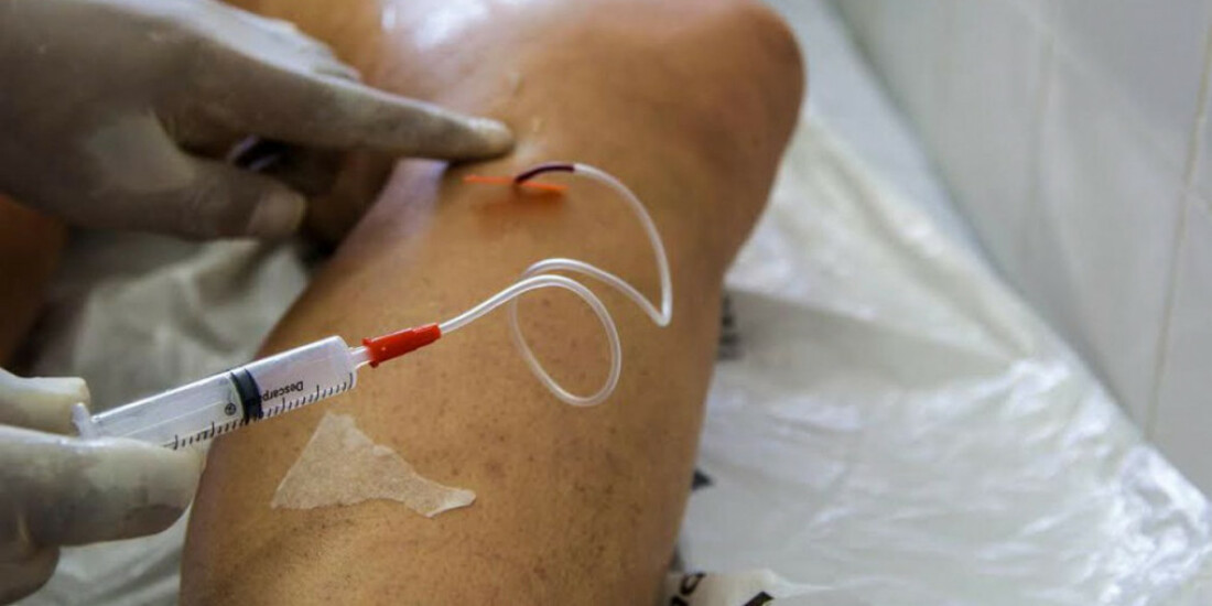 Pandemia fez cirurgias de varizes pelo SUS despencarem 69% no país