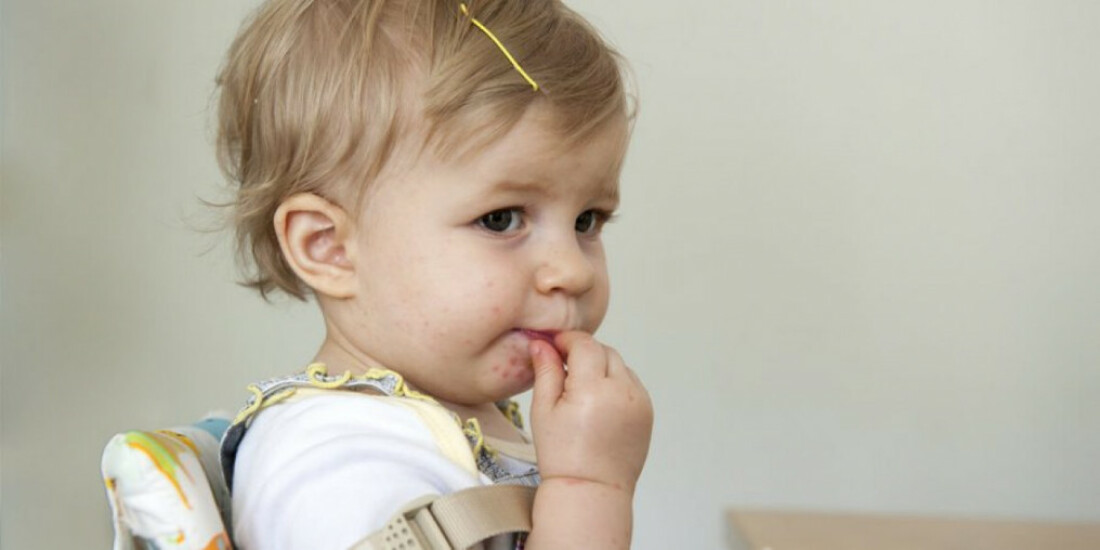 Surtos do vírus Mão-Pé-Boca aumentam 10 vezes em Mogi