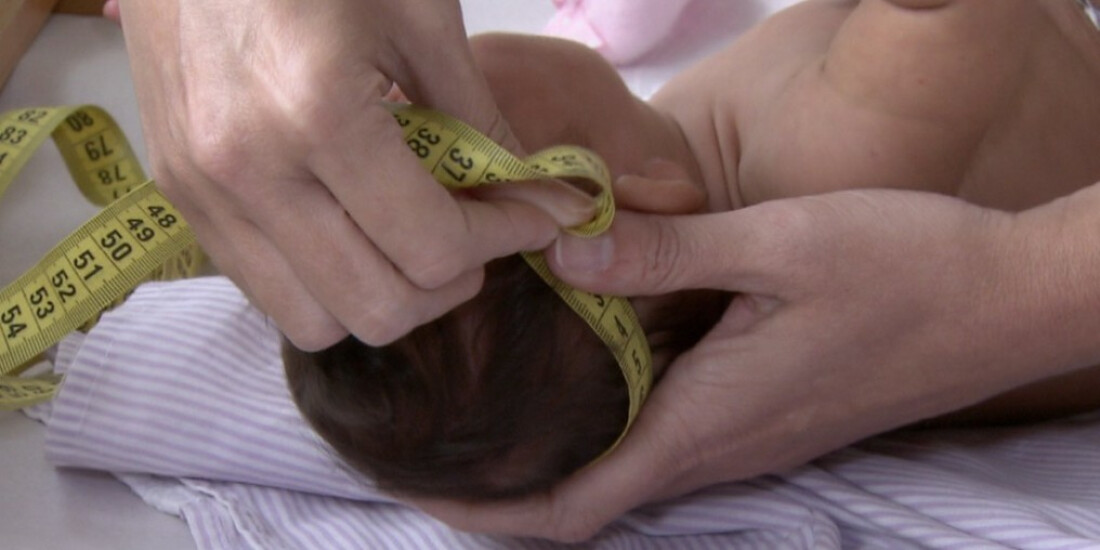 Crianças com síndrome congênita da zika têm mais chances de morrer