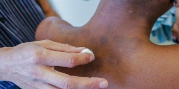 Pandemia de covid-19 faz notificações de hanseníase caírem 57% em 2021