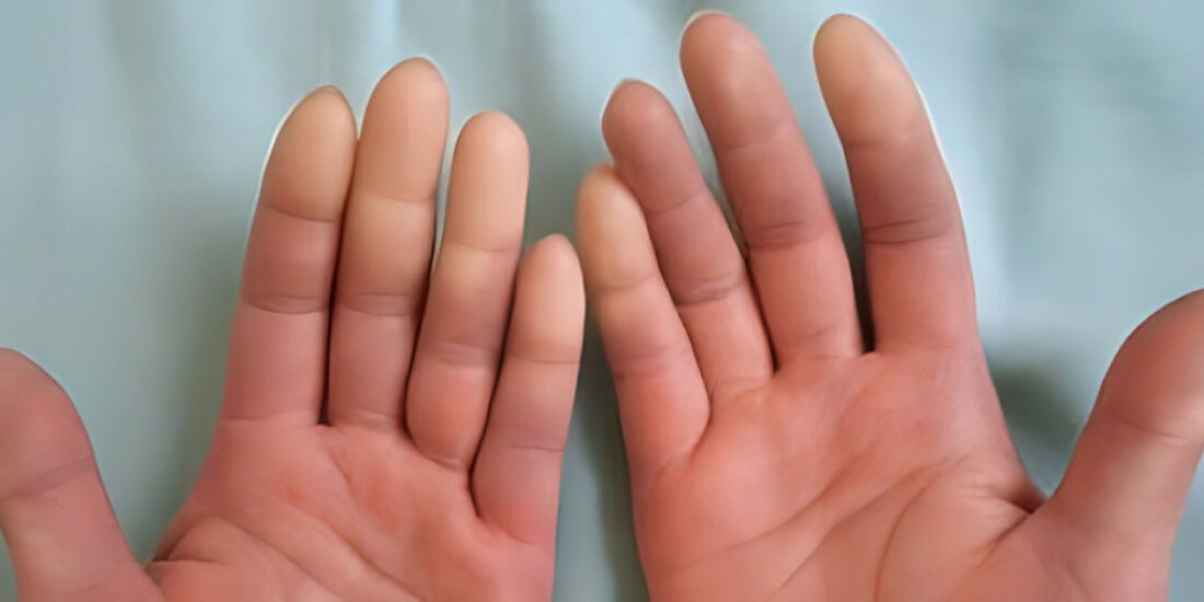 Especialista esclarece dúvidas sobre a esclerose sistêmica