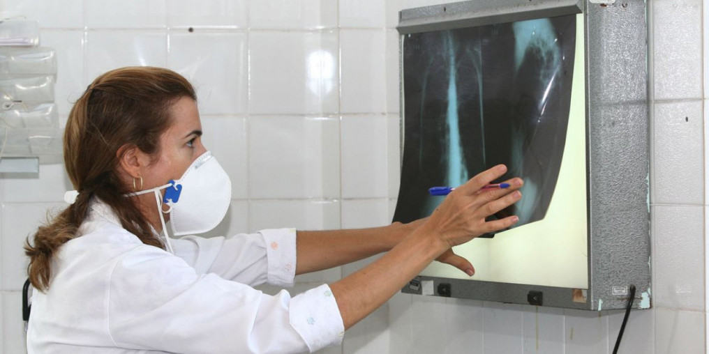 Brasil registra 78 mil novos casos de tuberculose