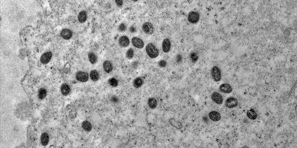 Pesquisa indica risco de monkeypox agravar infeccão por HIV
