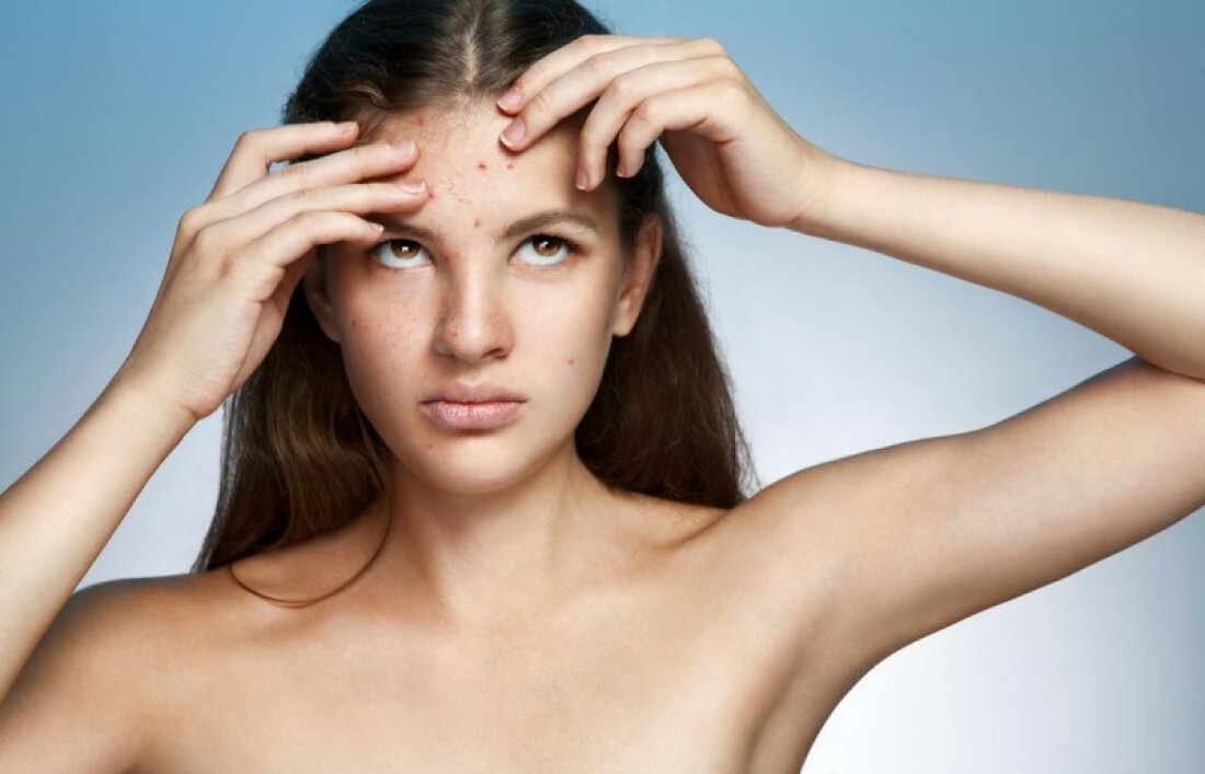 Acne afeta adolescentes e também mulheres adultas