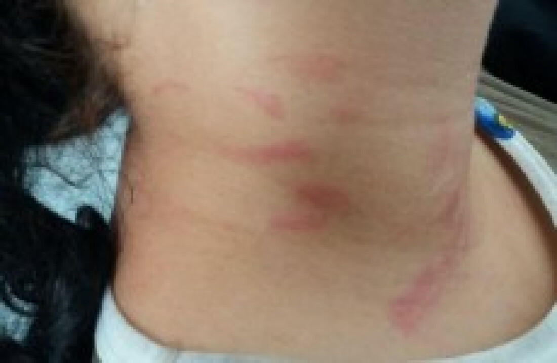 Mulher é agredida com mordidas por marido em Suzano