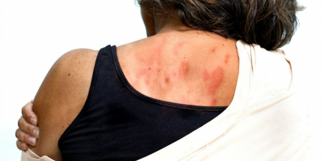 SAE de Ferraz fará busca ativa de hanseníase no Bom Prato