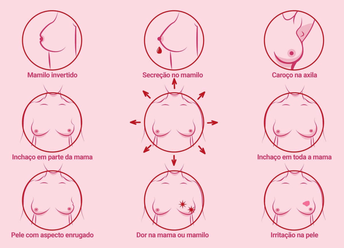 Câncer de mama tem alta taxa de mortalidade em mulheres