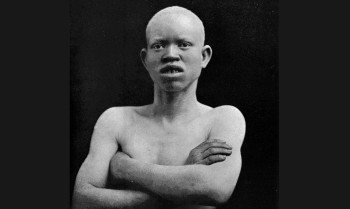 Dia de conscientização alerta sobre preconceito contra albinismo