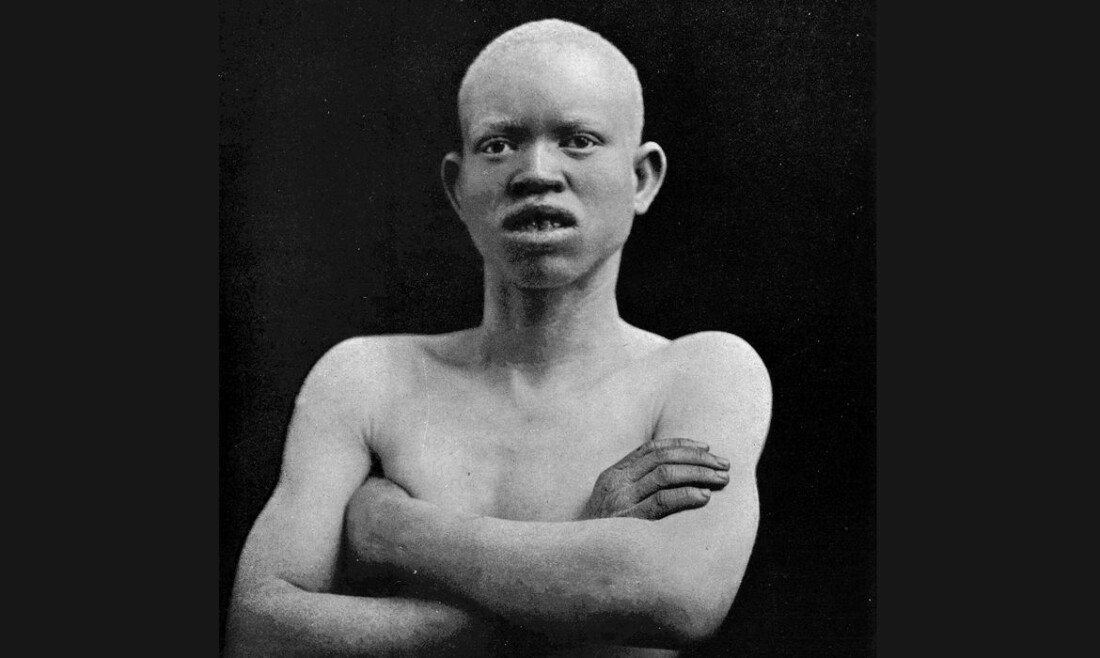 Dia de conscientização alerta sobre preconceito contra albinismo