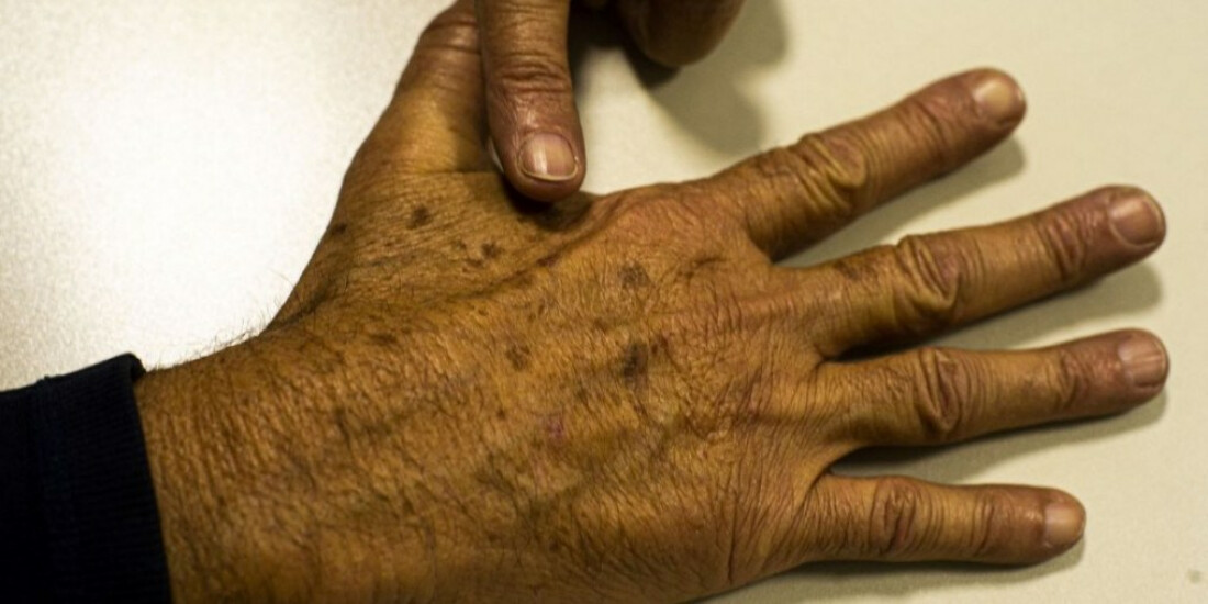 Sociedade médica lança campanha sobre prevenção do câncer de pele