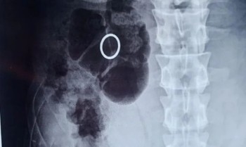 Homem é preso após furtar e engoliar anel avaliado em R$ 7,3 mil no Mogi Shopping